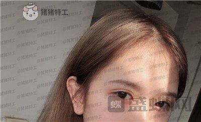 广东画美,牟北平,双眼皮,案例,价格,