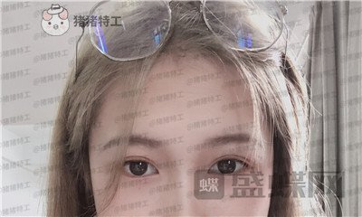 广东画美,牟北平,双眼皮,案例,价格,
