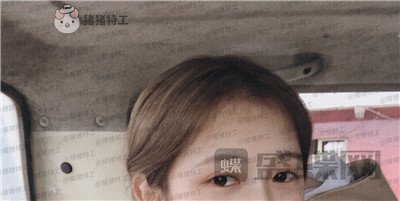 广东画美,牟北平,双眼皮,案例,价格,