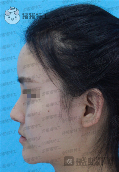 重庆华美,蒋琳,隆鼻,案例,价格,
