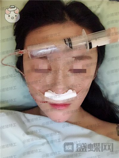 重庆华美,蒋琳,隆鼻,案例,价格,