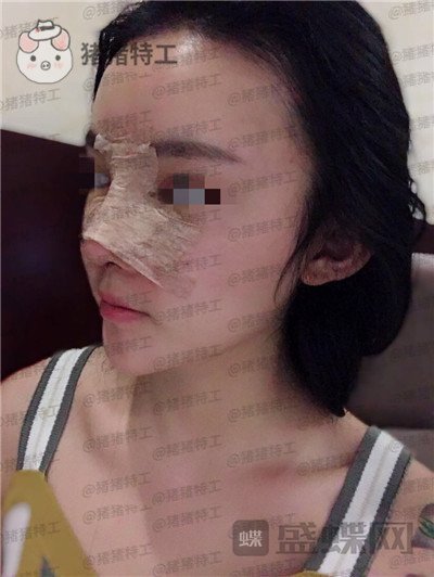 重庆华美,蒋琳,隆鼻,案例,价格,