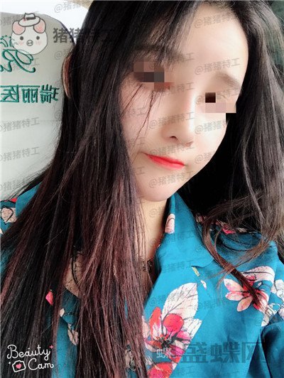 重庆华美,蒋琳,隆鼻,案例,价格,