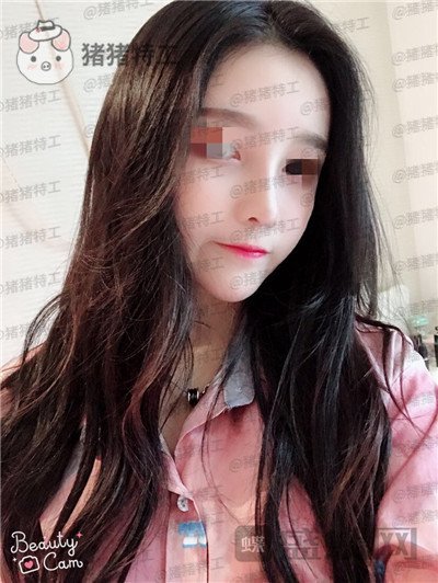 重庆华美,蒋琳,隆鼻,案例,价格,
