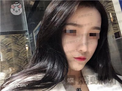 重庆华美,蒋琳,隆鼻,案例,价格,