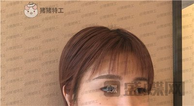 杭州艺星,杨连华,眼部手术,案例,价格,