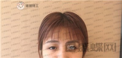 杭州艺星,杨连华,眼部手术,案例,价格,