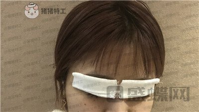 杭州艺星,杨连华,眼部手术,案例,价格,