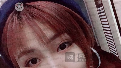 杭州艺星,杨连华,眼部手术,案例,价格,