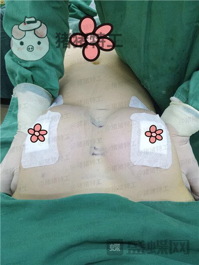 南京美贝尔,黄名斗,隆胸,案例,价格,