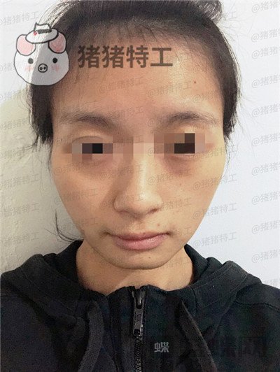 天津南开欧菲,闫腾元,面部填充,案例,价格,