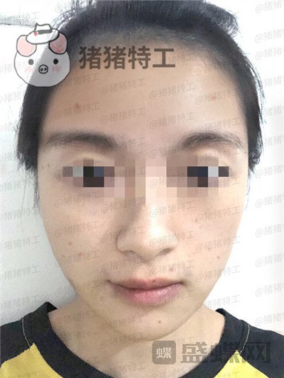 天津南开欧菲,闫腾元,面部填充,案例,价格,