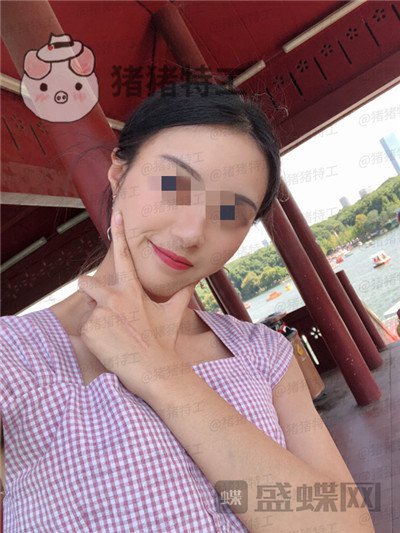 天津南开欧菲,闫腾元,面部填充,案例,价格,