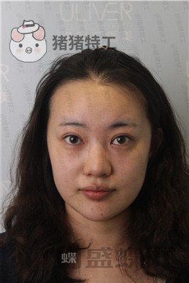 北京悦丽汇,姚然,鼻部手术,案例,价格,