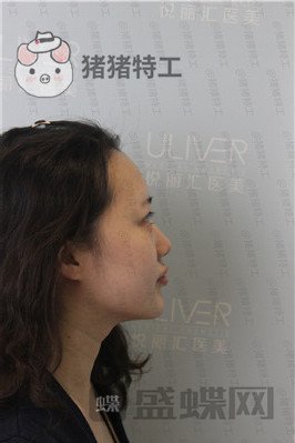 北京悦丽汇,姚然,鼻部手术,案例,价格,