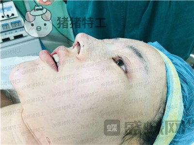 北京悦丽汇,姚然,鼻部手术,案例,价格,