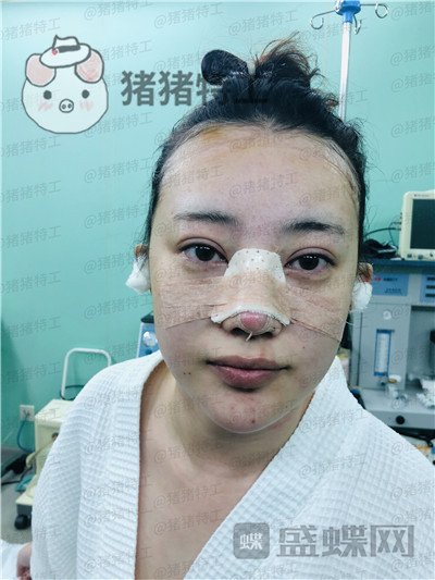 北京悦丽汇,姚然,鼻部手术,案例,价格,