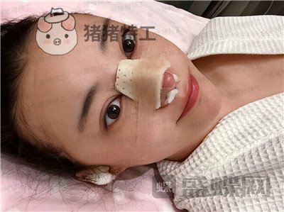 北京悦丽汇,姚然,鼻部手术,案例,价格,