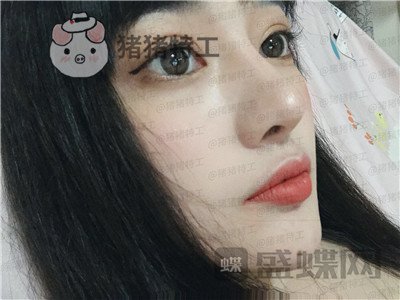 北京悦丽汇,姚然,鼻部手术,案例,价格,