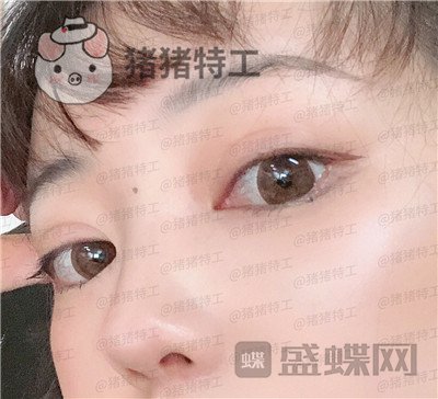 北京悦丽汇,姚然,鼻部手术,案例,价格,