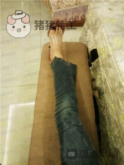 成都西区医院,毛健清,吸脂,案例,价格,