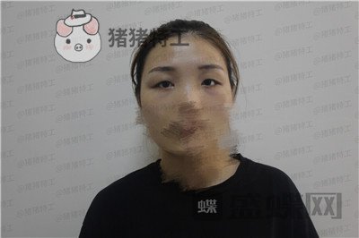 成都西区医院,车红昌,双眼皮,案例,价格,