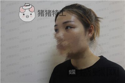 成都西区医院,车红昌,双眼皮,案例,价格,