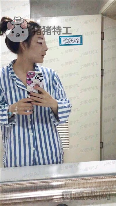 成都西区医院,车红昌,双眼皮,案例,价格,