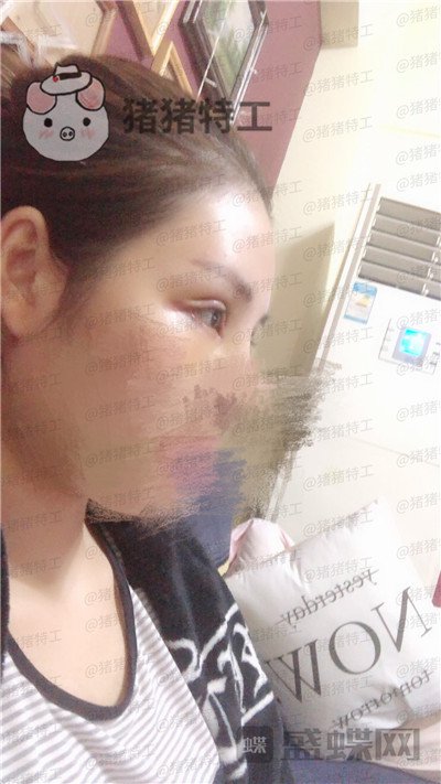 成都西区医院,车红昌,双眼皮,案例,价格,
