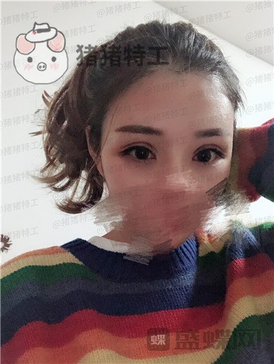 成都西区医院,车红昌,双眼皮,案例,价格,