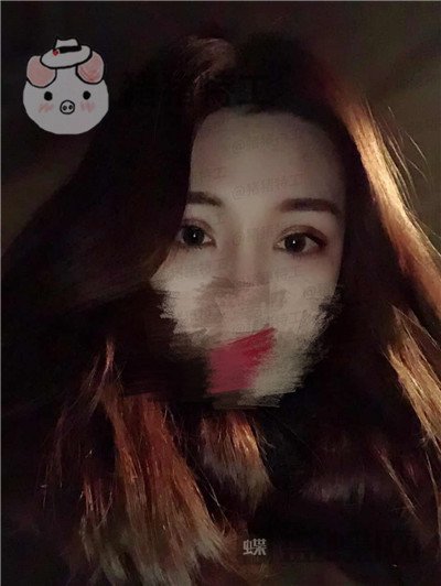 成都西区医院,车红昌,双眼皮,案例,价格,