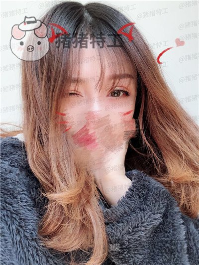 成都西区医院,车红昌,双眼皮,案例,价格,