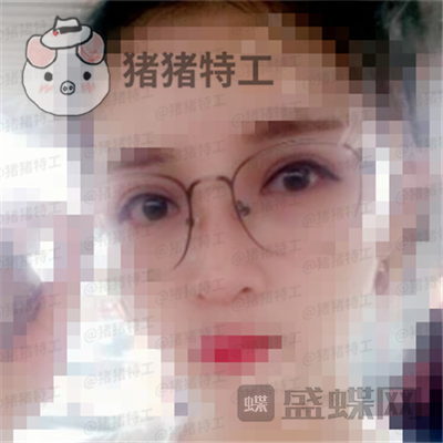 上海九院,魏皎,鼻部手术,案例,价格,