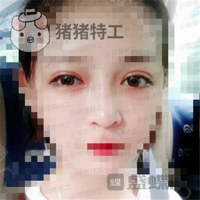 上海九院,魏皎,鼻部手术,案例,价格,