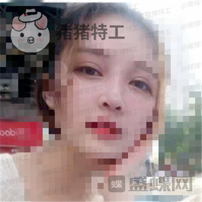 上海九院,魏皎,鼻部手术,案例,价格,