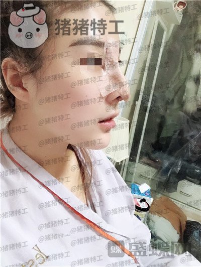 上海艺星,李建兵,隆鼻,案例,价格,
