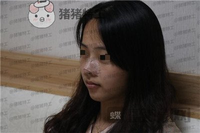 北京长虹,赵宏伟,隆鼻,案例,价格,