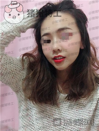北京长虹,赵宏伟,隆鼻,案例,价格,