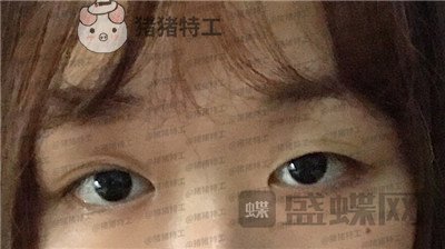 兰州时光,罗梅,眼部手术,案例,价格,