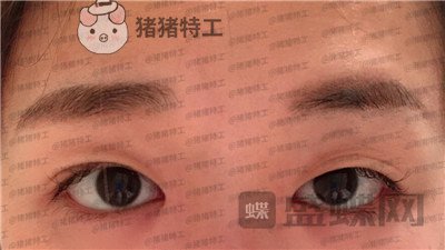 兰州时光,罗梅,眼部手术,案例,价格,