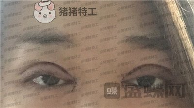 兰州时光,罗梅,眼部手术,案例,价格,