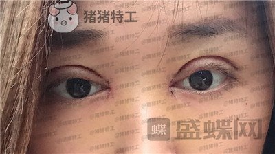 兰州时光,罗梅,眼部手术,案例,价格,