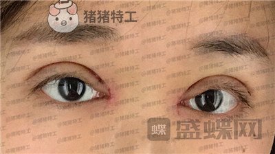 兰州时光,罗梅,眼部手术,案例,价格,