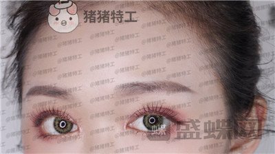 兰州时光,罗梅,眼部手术,案例,价格,