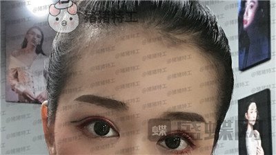 兰州时光,罗梅,眼部手术,案例,价格,