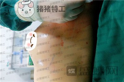 北京华悦府,王宁博,隆胸,案例,价格,
