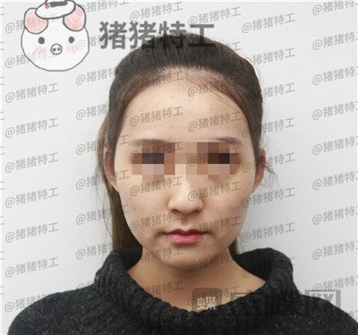 重庆华美,潘宝华,颧骨整形,案例,价格,