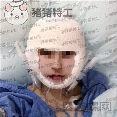 重庆华美,潘宝华,颧骨整形,案例,价格,