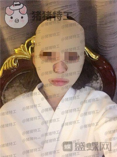 重庆华美,潘宝华,颧骨整形,案例,价格,