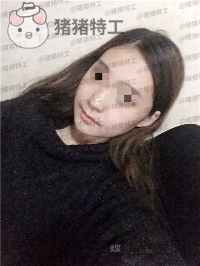 重庆华美,潘宝华,颧骨整形,案例,价格,